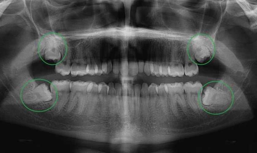 Chụp X-quang răng là gì? Có những loại nào?