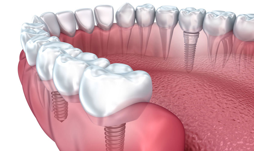 Răng Implant được cố định trong xương như răng thật