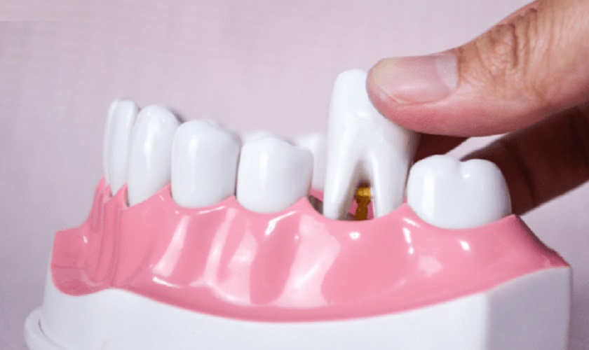 Mất răng số 7 hàm dưới và giải pháp điều trị