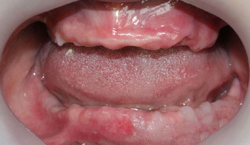 Mất răng toàn hàm và giải pháp phục hồi tối ưu nhất