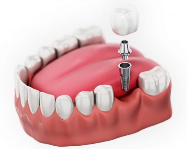 Cấy ghép răng Implant là kỹ thuật được khuyến khích để điều trị rụng răng cấm