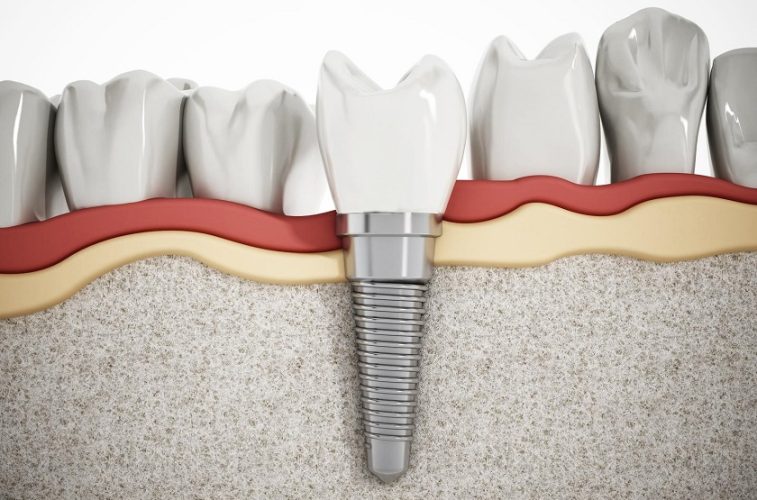 Thay thế răng mất bằng cách trồng 1 răng Implant