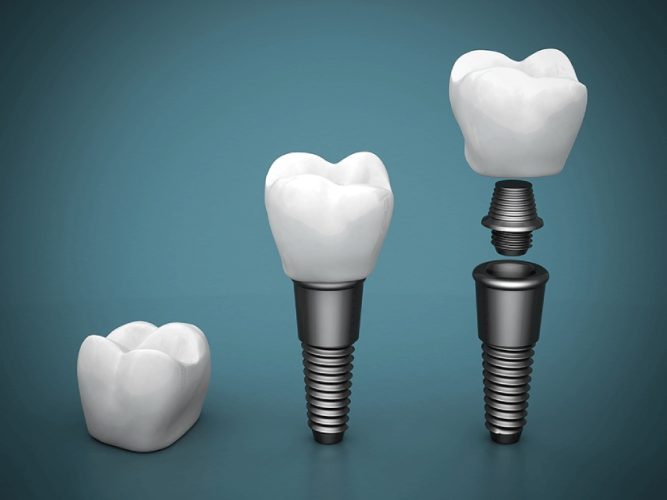 Lựa chọn các loại vật liệu cấy ghép phù hợp để đạt hiệu quả cao với chi phí tiết kiệm nhất