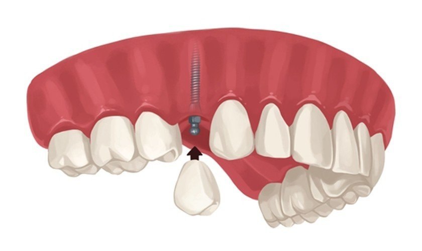 Trồng Implant đơn lẻ giải pháp bảo vệ các răng liền kề hiệu quả nhất