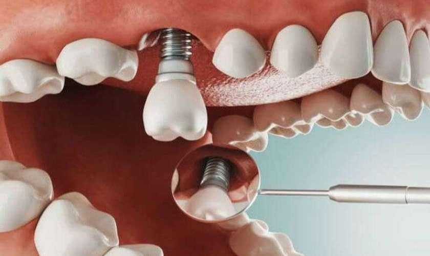 Dựa vào vị trí răng mất nằm ở đâu bác sĩ sẽ đưa ra kế hoạch điều trị và giá trồng Implant đơn lẻ phù hợp với từng bệnh nhân
