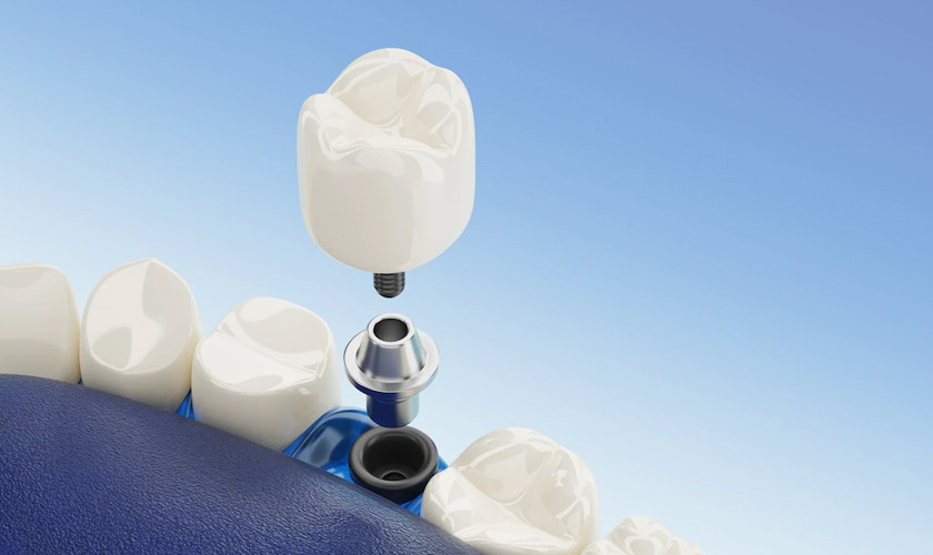 Bác sĩ sẽ thông báo giá trồng Implant đơn lẻ dựa vào số lượng trụ Implant cần sử dụng