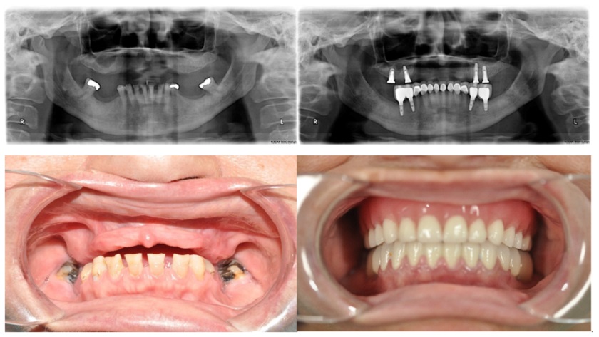Phục hình hàm giả tháo lắp trên Implant có thể áp dụng cho người mất toàn bộ răng ở 1 hoặc cả 2 hàm