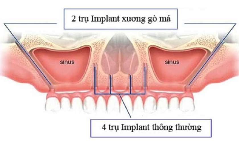 Kỹ thuật Implant xương gò má là giải pháp tái tạo chức năng nhai và thẩm mỹ cho hàm răng