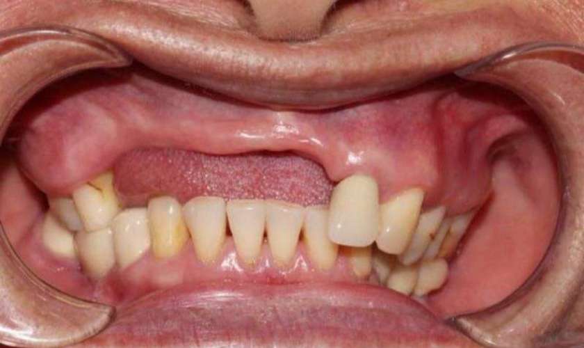 Implant xương gò má là giải pháp tối ưu cho người bị mất răng hàm trên, tiêu xương nghiêm trọng