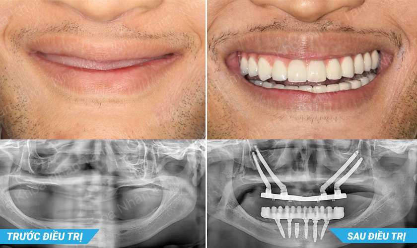 Kỹ thuật Implant xương gò má mang lại hiệu quả rõ rệt sau khi cấy ghép