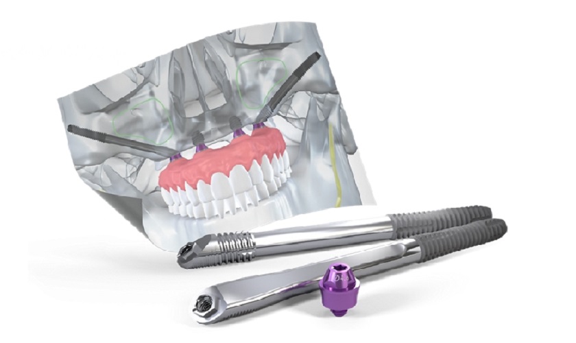 Phương pháp cấy Implant xương gò má – Zygoma Implant 1 Implant xương gò má