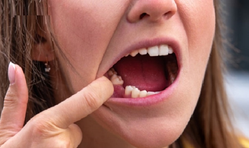 Hậu quả mất răng hàm và 3 cách khắc phục khi răng hàm bị mất