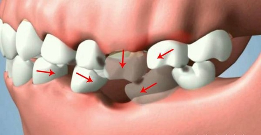 Mất răng hàm gây xô lệch răng và sai khớp cắn