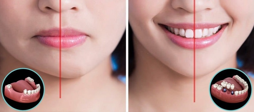 Phục hình Implant trong trường hợp mất răng hàm