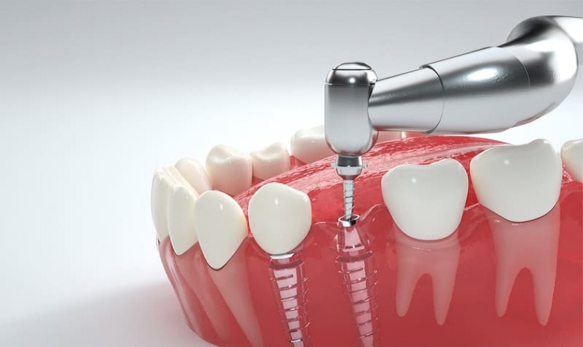 Kỹ thuật cấy răng Implant tại Implant Center
