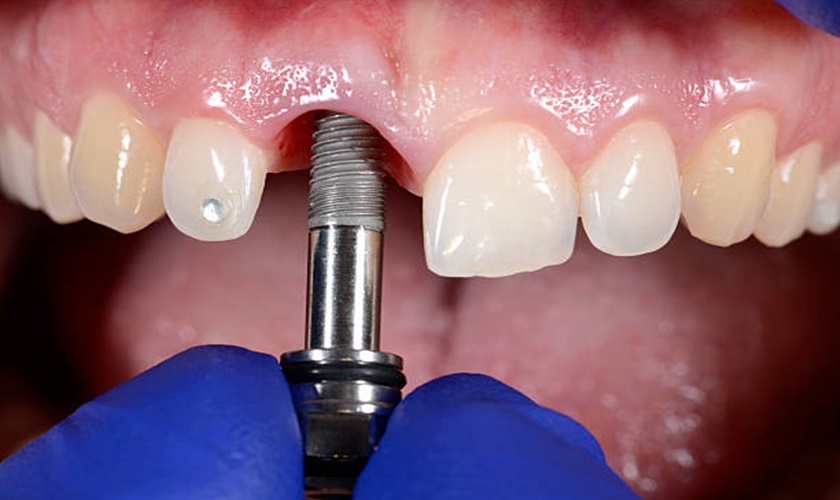 Lấy dấu răng Implant là kỹ thuật rất quan trọng