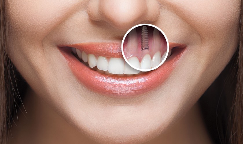 Răng Implant có độ bền cao