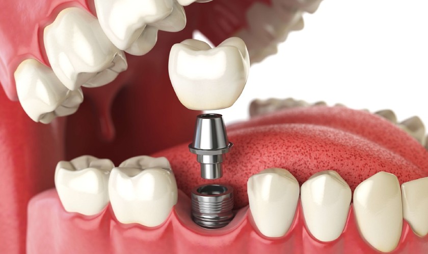 Trồng răng Implant không cần phải mài răng như cầu răng sứ