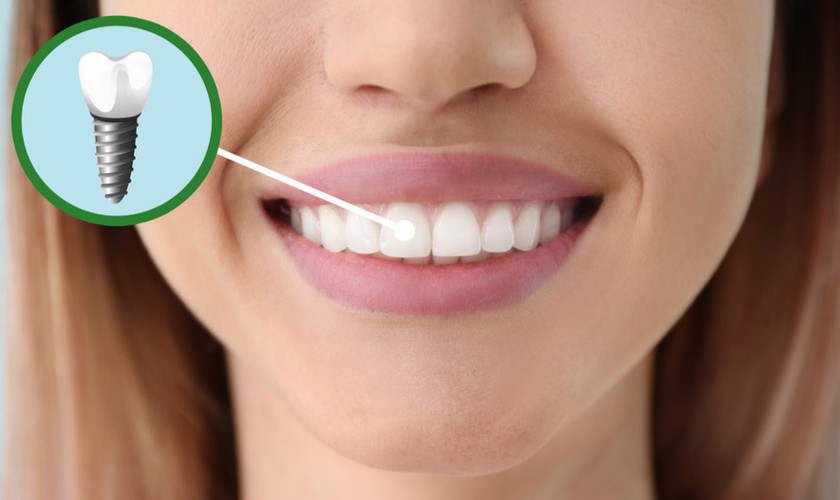 Trồng răng Implant mang đến cho bạn nụ cười tự nhiên như răng thật