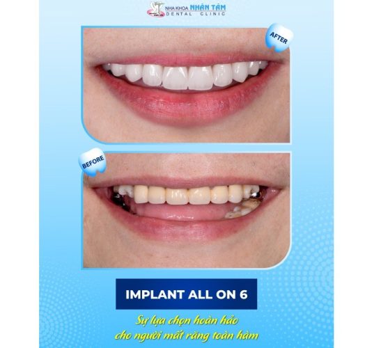 Khách hàng trồng răng Implant tại Implant Center