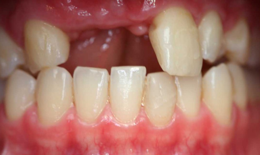 Mất răng cửa gây ảnh hưởng đến thẩm mỹ của khuôn mặt