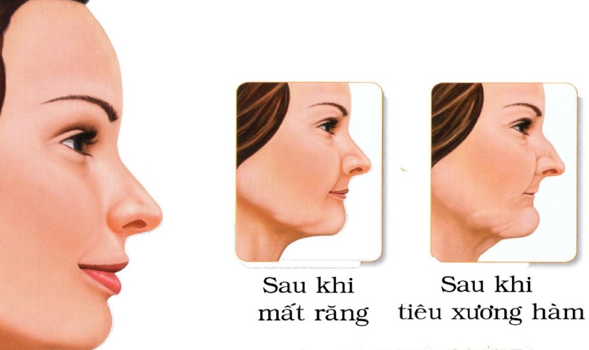 Mất răng lâu ngày sẽ dẫn đến tiêu xương hàm