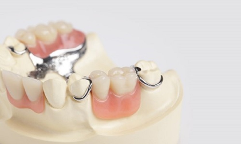 Răng giả tháo lắp có chi phí phải chăng