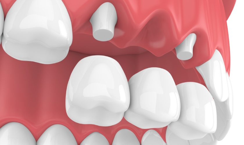 Cầu răng sứ đảm bảo được thẩm mỹ và ăn nhai cho khách hàng