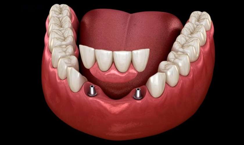 Mất 4 răng liên tiếp nên khắc phục bằng phương pháp nào?