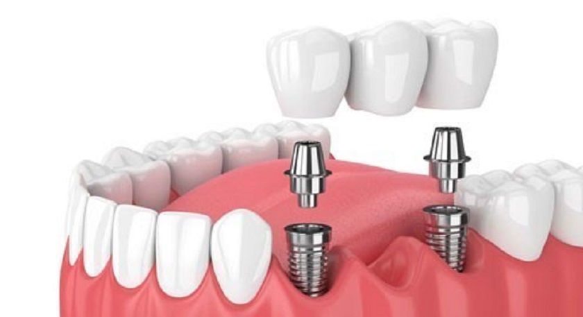 Khắc phục mất răng sớm bằng kỹ thuật cấy ghép Implant