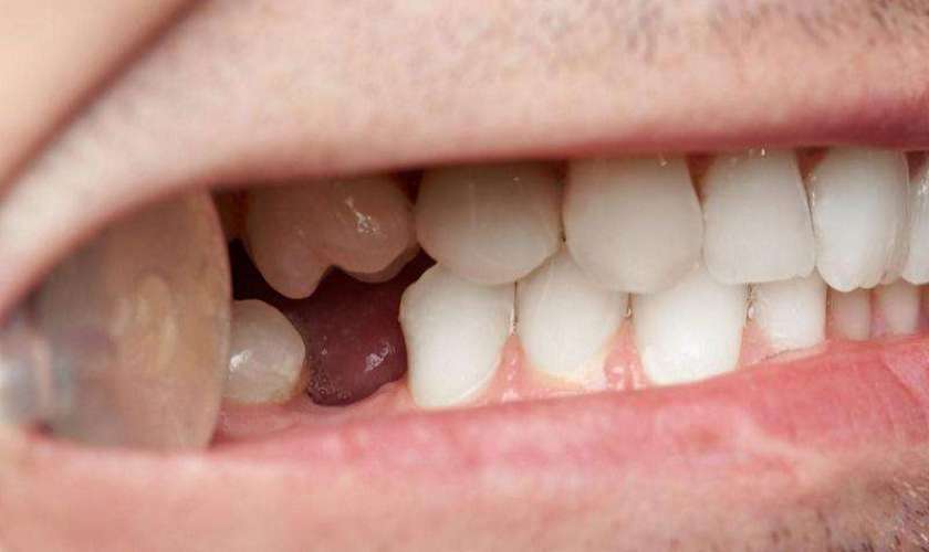 Mất răng số 6: Tại sao nên ưu tiên phục hình ngay lập tức?