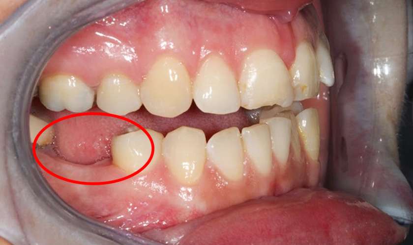 Mất răng số 6 làm lệch các răng bên cạnh
