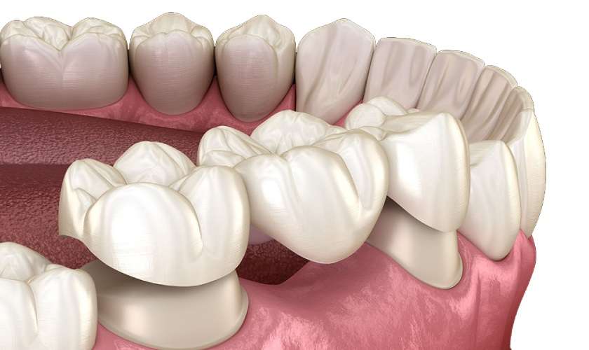 Cầu răng sứ một trong những phương pháp trồng răng số 6 phổ biến hiện nay