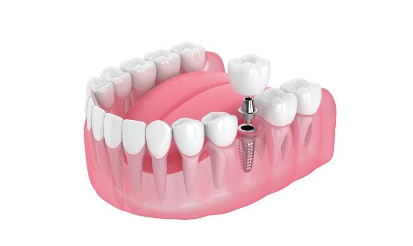 Trồng răng Implant phương pháp hiệu quả khắc phục mất răng số 6