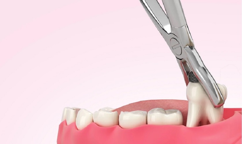 Nhổ răng có phải trồng lại không? Nên trồng bằng cách nào?