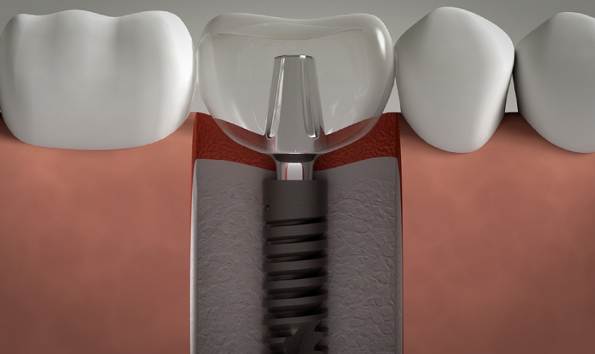 Nong xương trong cấy ghép răng Implant