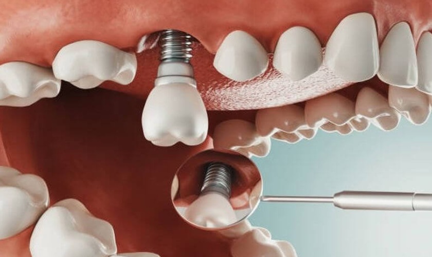 Phẫu thuật ghép xương tự thân để cấy ghép Implant