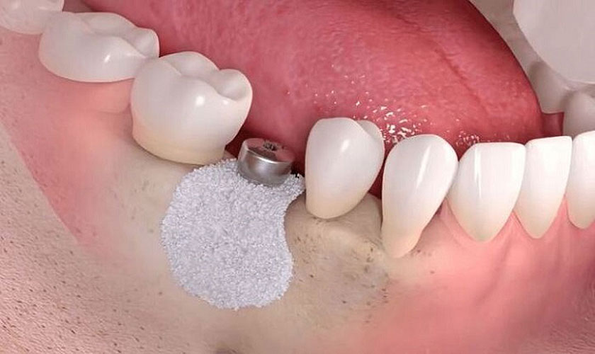 Ghép xương tự thân giúp ổn định mật độ xương hàm để cấy ghép Implant