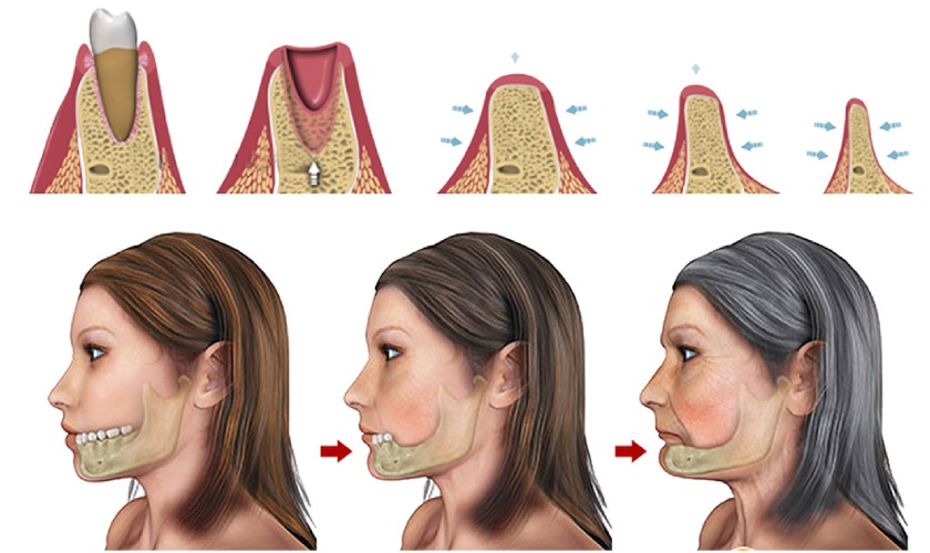 Khách hàng bị tiêu xương cần tiến hành ghép xương
