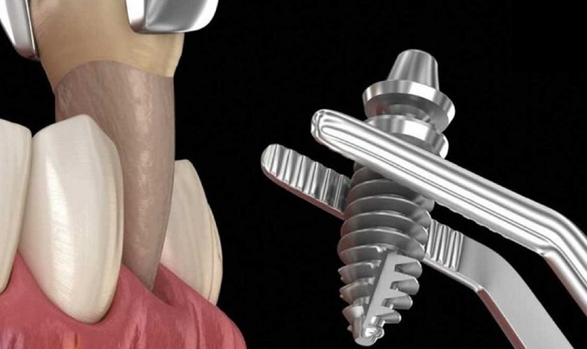 Nên thực hiện trồng răng Implant càng sớm càng tốt
