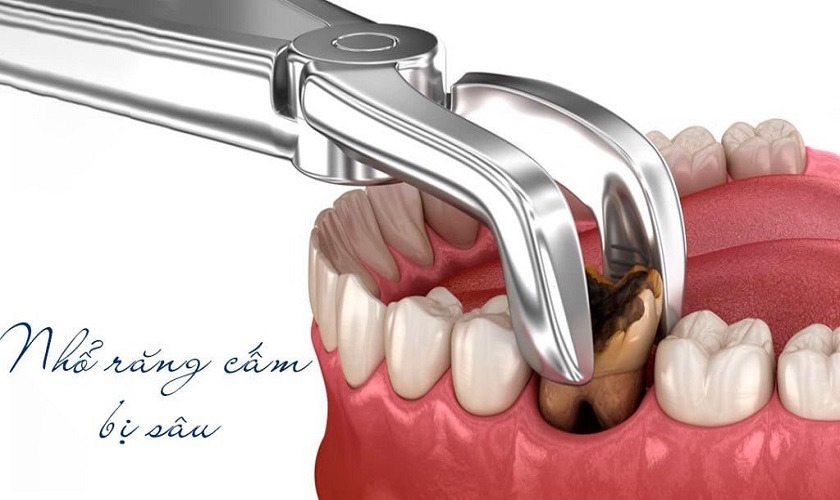 Răng cấm bị sâu điều trị thế nào? Có nên nhổ không?