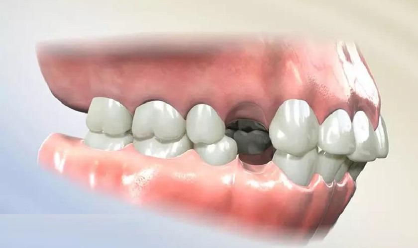 Mất răng số 4 nên trồng lại bằng cách nào