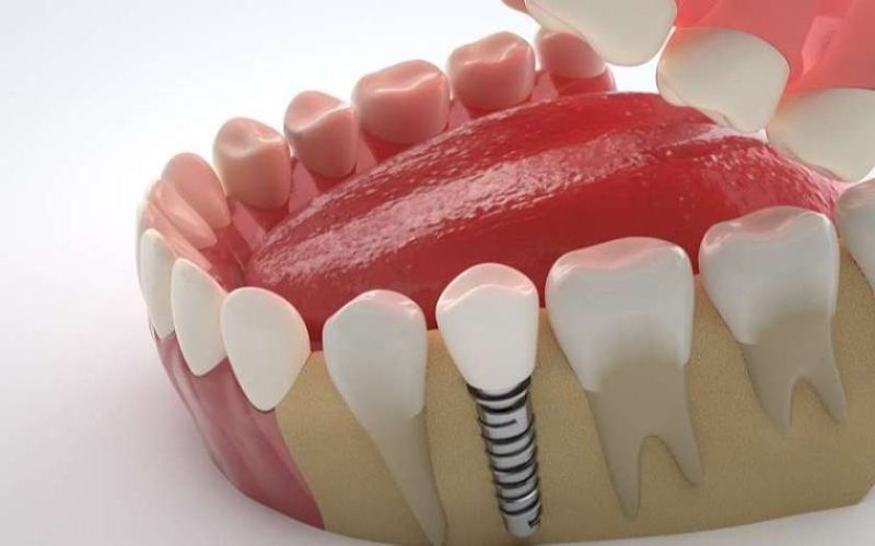 Trồng Implant đơn lẻ và những điều cần biết