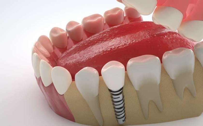 Trồng Implant đơn lẻ và những điều cần biết