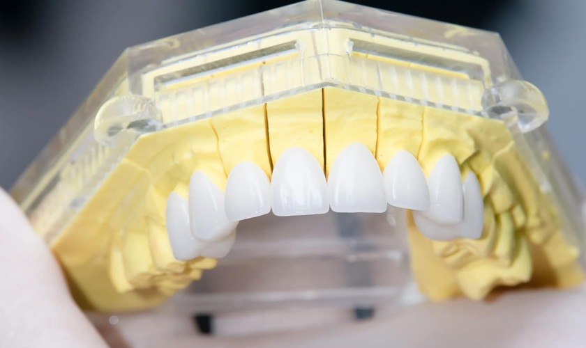 Chất liệu răng sứ không đảm bảo sẽ gây kích ứng với khoang miệng, dẫn đến hôi miệng