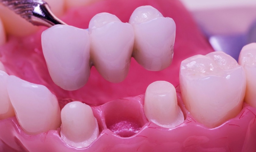 Cầu răng sứ không ngăn ngừa được tình trạng tiêu xương