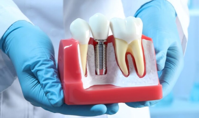 Cấy ghép Implant là giải pháp trồng răng tiên tiến nhất hiện nay