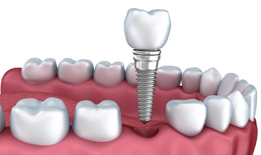 Cấy ghép Implant