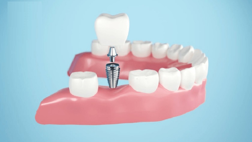 Trồng răng giả vĩnh viễn bằng Implant nha khoa