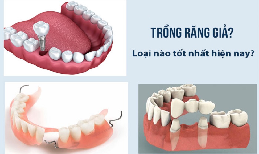 Trồng răng Implant cầu răng sứ hàm tháo lắp